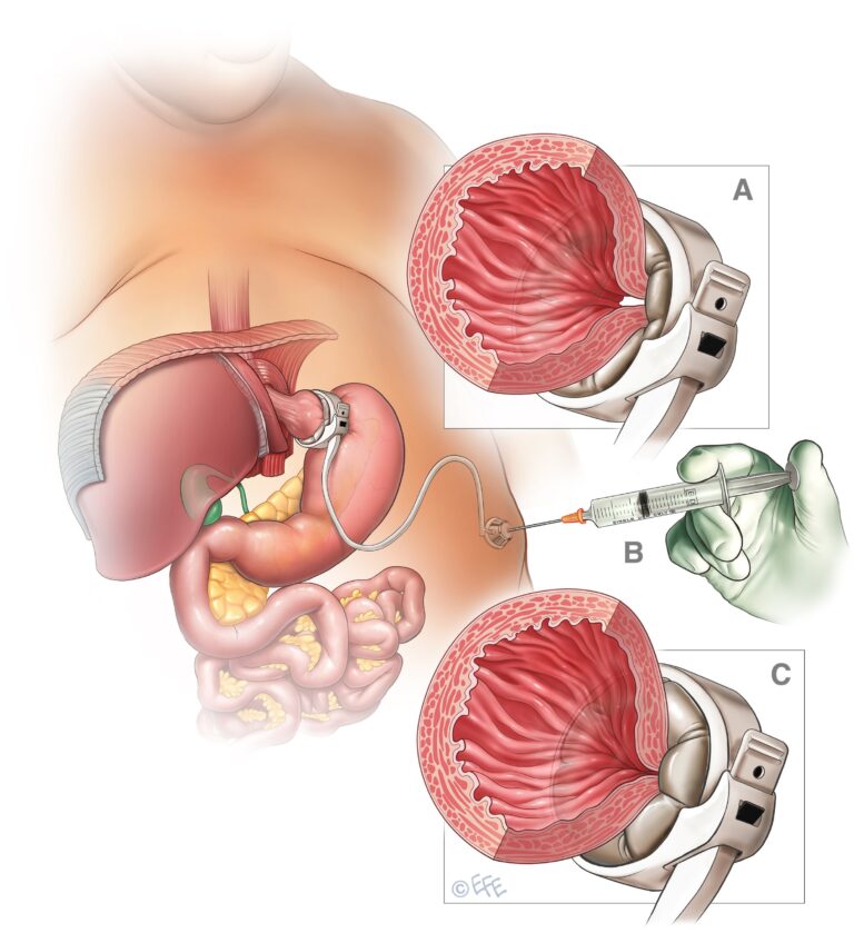 Bendaggio gastrico