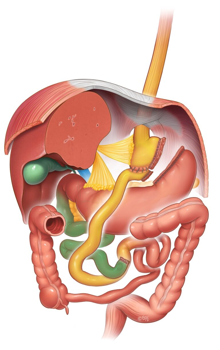 Bypass gastrico