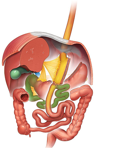 Mini bypass gastrico