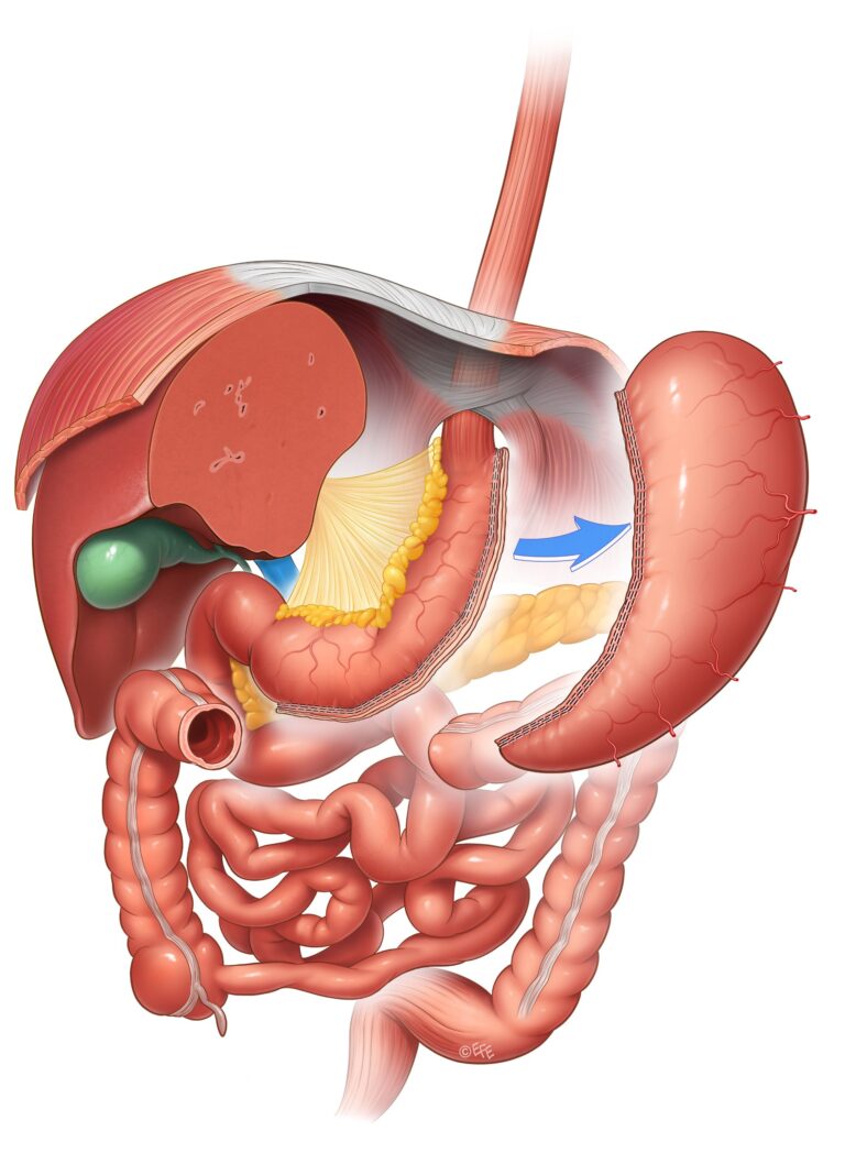 Sleeve gastrectomy